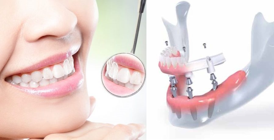 Jokių išimamųjų protezų – tikri dantys per vieną dieną