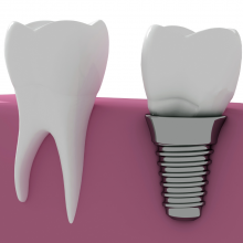 Dilema: saugoti esamus dantis ar sriegti implantus?