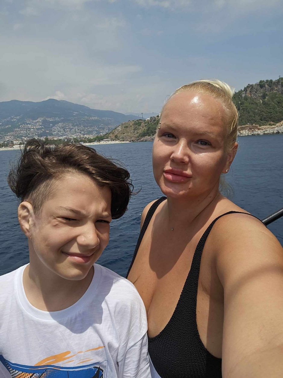 Šuns sukandžioto berniuko mama: matydama iš gabalų surinktą sūnų, išmokau pamoką