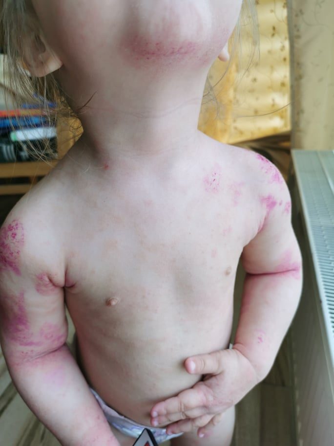 Stipriai išbertos mažametės mama: alergiją sukėlė skiepai