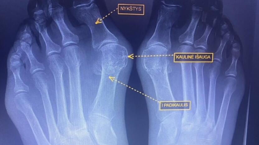 Hallux valgus: šioje rentgeno nuotraukoje matyti, kaip atrodo deformuotas pėdos kauliukas.