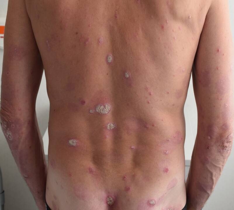Įtaka: S.Valiukevičienės teigimu, vienas iš veiksnių, lemiančių ne psoriazės atsiradimą, bet paūmėjimą, yra lėtinis stresas arba stipri nervinė įtampa.