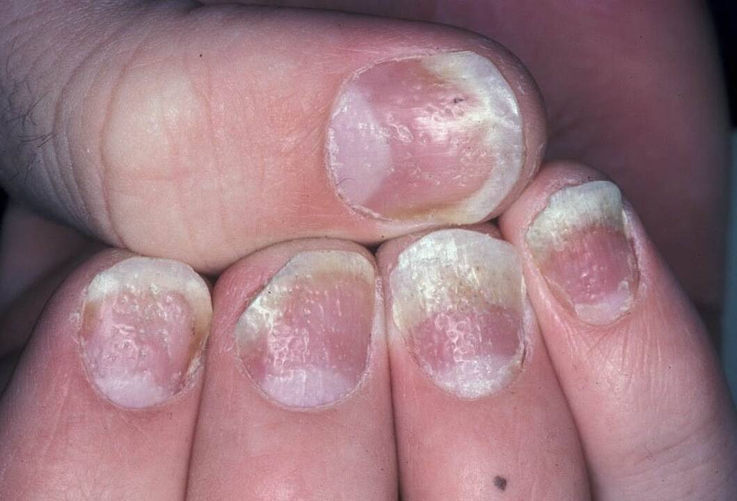 Įtaka: S.Valiukevičienės teigimu, vienas iš veiksnių, lemiančių ne psoriazės atsiradimą, bet paūmėjimą, yra lėtinis stresas arba stipri nervinė įtampa.