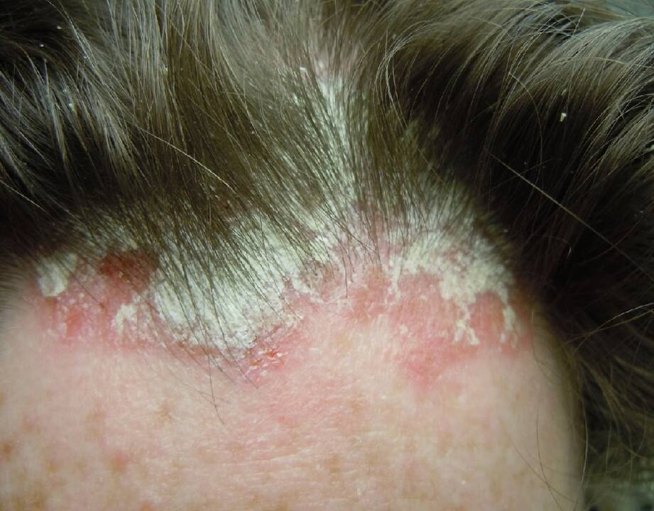 Įtaka: S.Valiukevičienės teigimu, vienas iš veiksnių, lemiančių ne psoriazės atsiradimą, bet paūmėjimą, yra lėtinis stresas arba stipri nervinė įtampa.