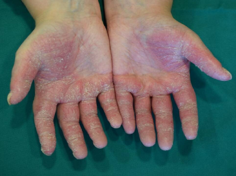 Įtaka: S.Valiukevičienės teigimu, vienas iš veiksnių, lemiančių ne psoriazės atsiradimą, bet paūmėjimą, yra lėtinis stresas arba stipri nervinė įtampa.