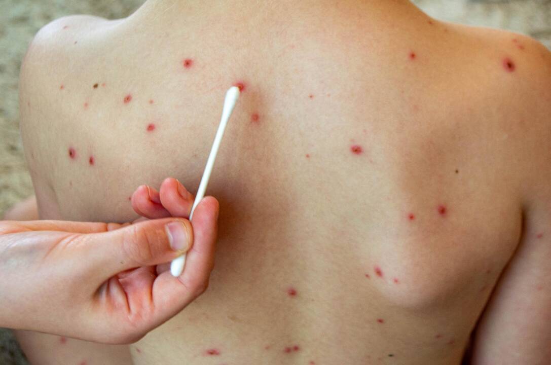 Įspėja – šiemet galime vėl sulaukti tymų protrūkio