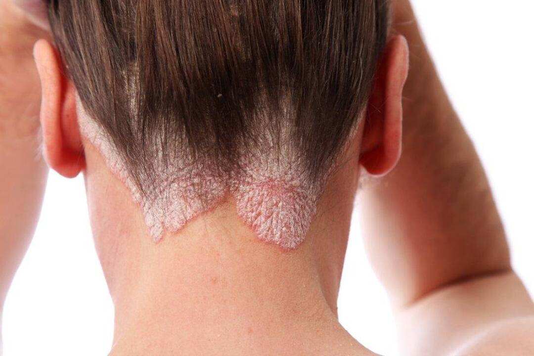Biologiniai vaistai – priemonė suvaldyti žvynelinę