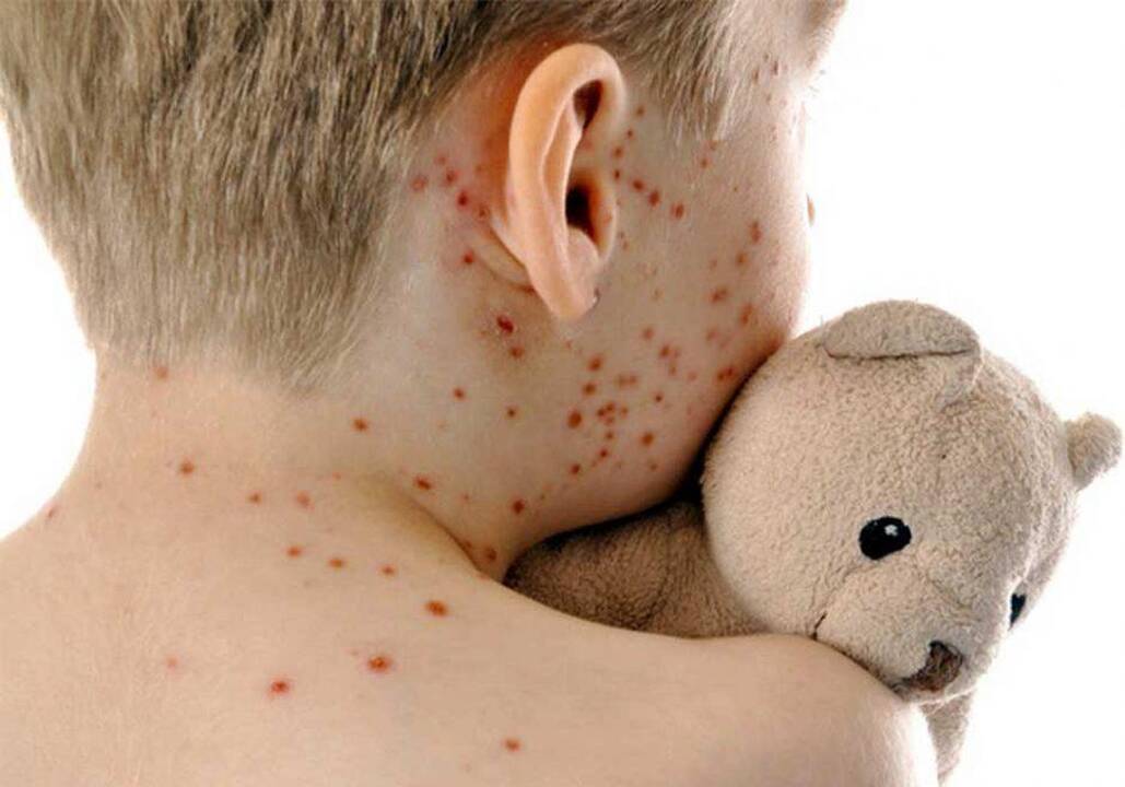 Tymai sugrįžta: medikai ragina nepamiršti pasiskiepyti