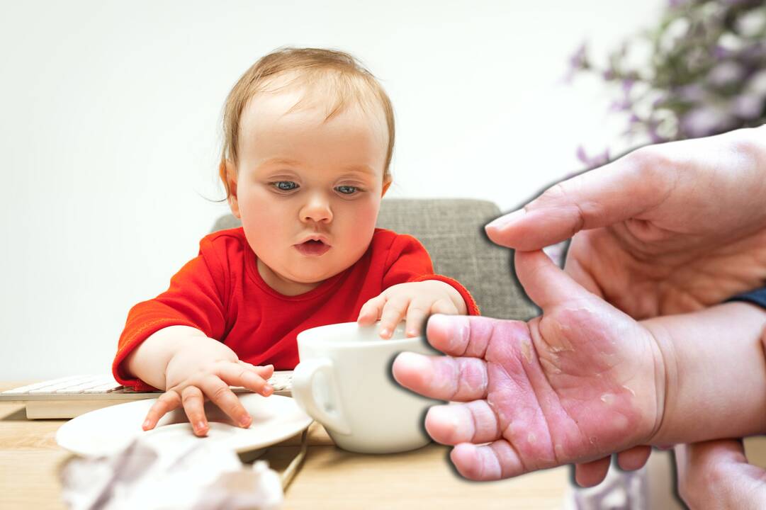 Daugiau apie karštais gėrimais apsiplikiusius mažylius: vienas į ligoninę atvežtas tik kitą dieną