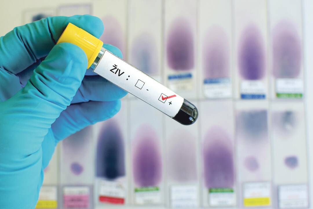 Rekomendacija: kai patvirtinama teigiama ŽIV diagnozė, gydymo svarbu kreiptis iš karto.
