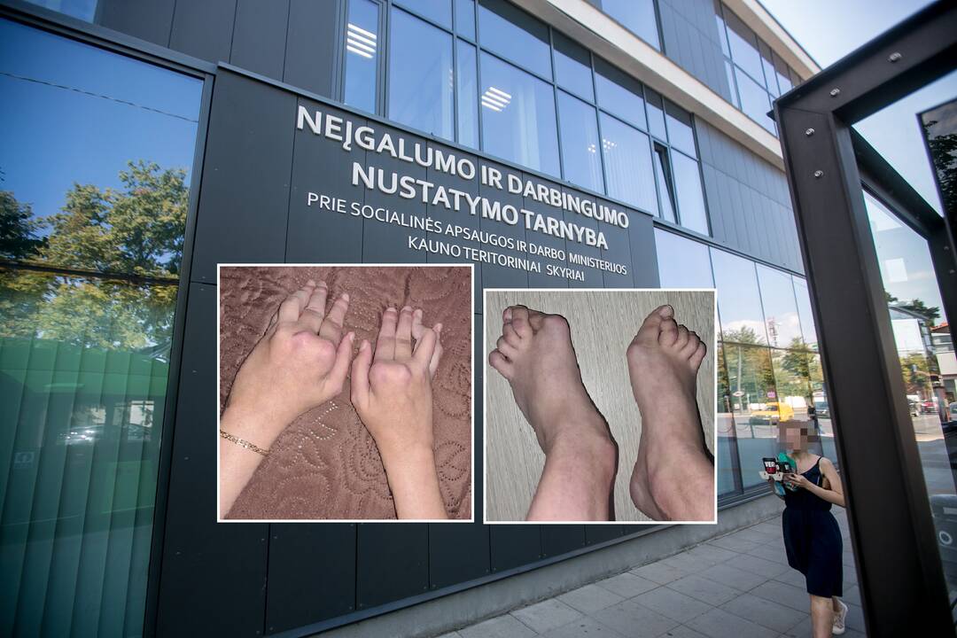 Negalia: dėl rankų ir kojų sąnarių deformacijų mergina negali neprisilaikydama vaikščioti ir atlikti daugelio rankų darbo reikalaujančių darbų, tačiau NDNT nustatė, kad ji gali dirbti vairuotoja, kelti krovinius iki 10 kg, dirbti kitus darbus.