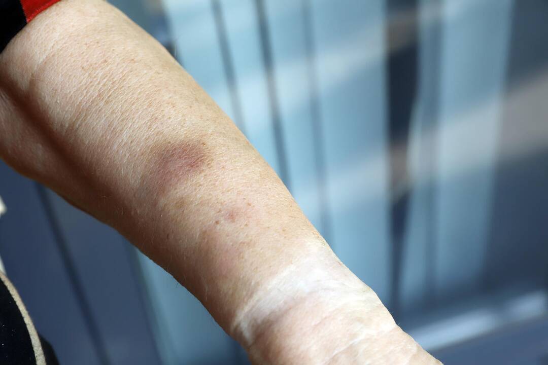 Įrodymas: Bronislavos teigimu, kontrolierė-konduktorė, naudodama jėgą, griebė jai už ant krūtinės sukryžiuotų rankų, prispaudė ir šaukdama grasino.