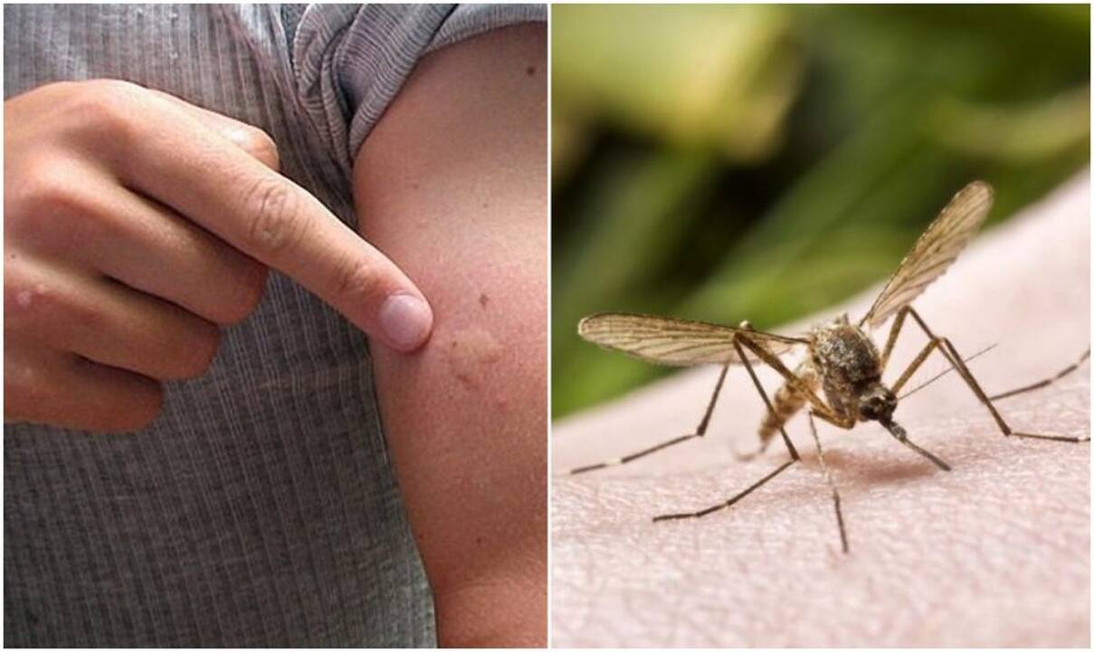 Gydytojos patarimai: kaip apsisaugoti nuo vabzdžių