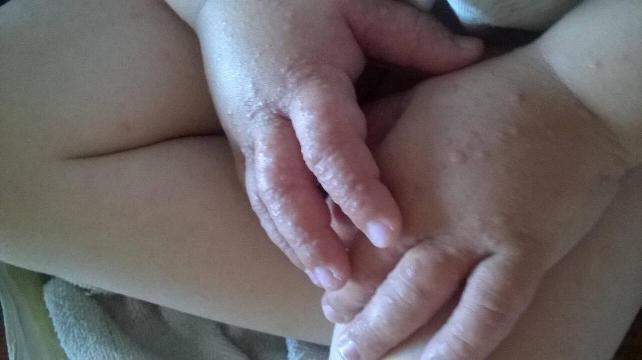 Jūratė buvo labai išsigandusi, kai pastebėjo jokiai ligai nebūdingus sūnaus susirgimo požymius, bet, laimė, vaikas sirgo nesunkiai.