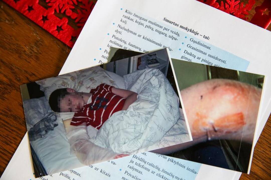 Po košmaro mokykloje – deformuota vaiko ranka ir vadovų abejingumas