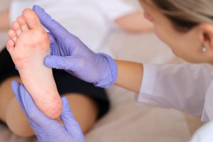 JAV dviem vaikams nustatyti beždžionių raupai