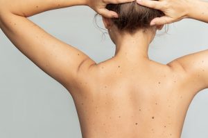 Melanoma serga ir jauni: kas apie tai įspėja?
