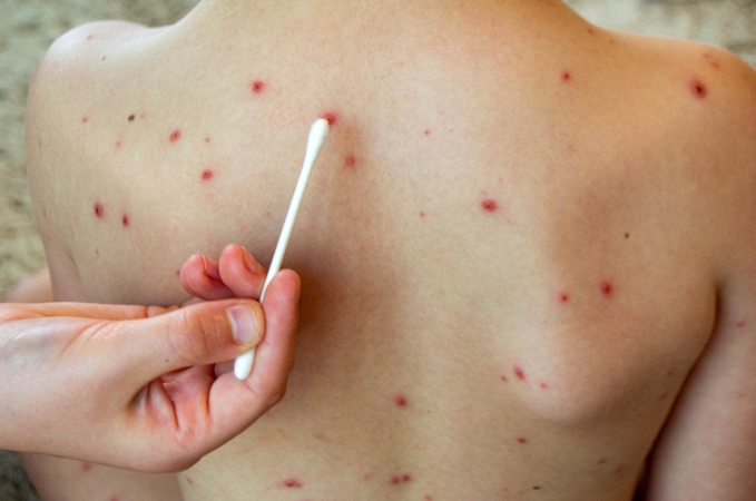 Įspėja – šiemet galime vėl sulaukti tymų protrūkio