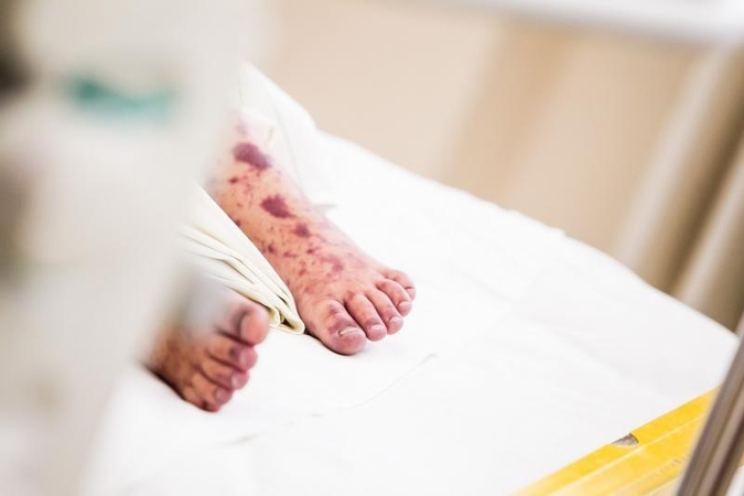 Įspėja: meningokokinės infekcijos sukėlėjus nešioja kas dešimtas žmogus