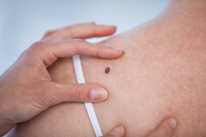 Kodėl melanoma pelnė juodojo vėžio vardą?
