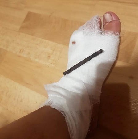 Strypas pervėrė klaipėdietės pėdą