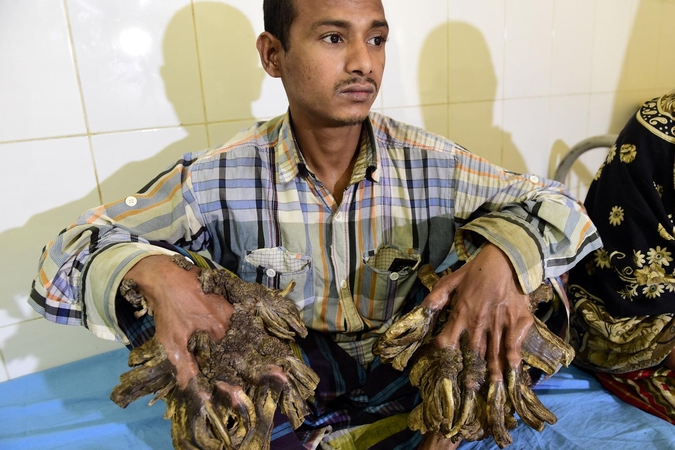 „Žmogui medžiui“ iš Bangladešo sėkmingai atlikta operacija