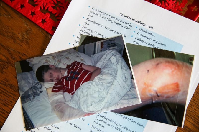 Po košmaro mokykloje – deformuota vaiko ranka ir vadovų abejingumas